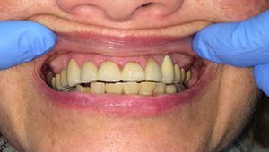 worn down teeth repaired
