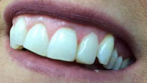 Cracked tooth repaired with dental crown