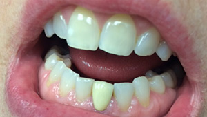 Protruding bottom tooth before treatment