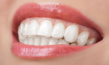 woman wearing teeth whitening tray