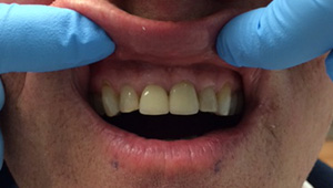 Healthy and repaired upper tooth after