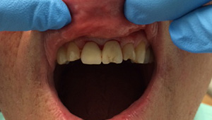 Decayed and cracked upper tooth before