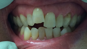 Broken front tooth before