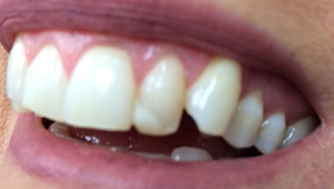 Cracked top tooth before