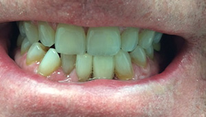 Healthy smile after extraction and alignment