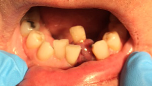 Severely misaligned teeth before