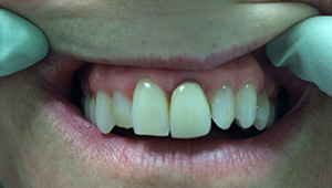 Protruding top teeth before