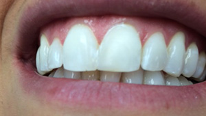 Flawless smile after veneers