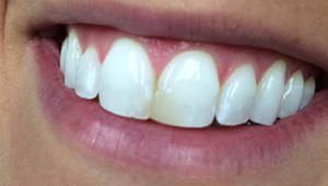 Dark front tooth before