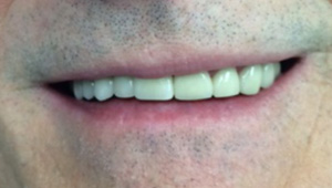 Replaced top row of teeth