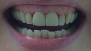 Healthy aligned front teeth after