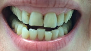 Decayed and overlapping front teeth before