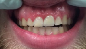 Repaired chipped tooth after