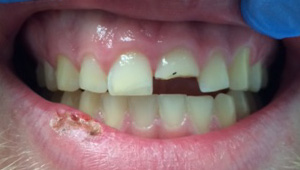 Chipped tooth before