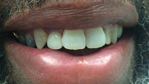 Perfectly aligned teeth after