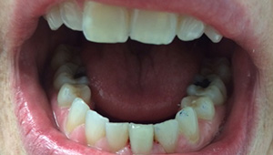Healthy smile after treatment
