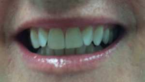Oversized front teeth before treatment