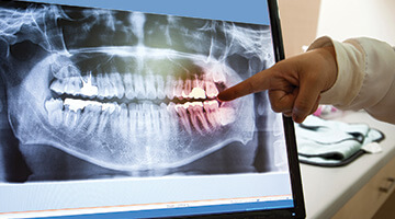 dentist pointing to red spot on x-ray