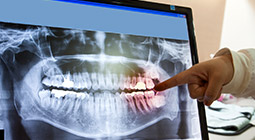 Digital dental x-rays on computer screen