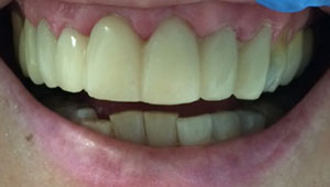 Healthy white smile after treatment