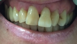 Yellowed damaged teeth before treatment
