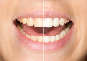 Get your summer smile brighter with teeth whitening in Jacksonville!