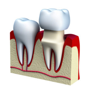 Curious about how dental crowns in Jacksonville can benefit you? Dr. Sol Brotman explains everything you need to know. 