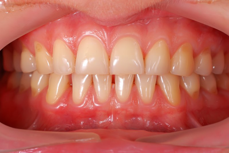 A mouth with mild gum disease.